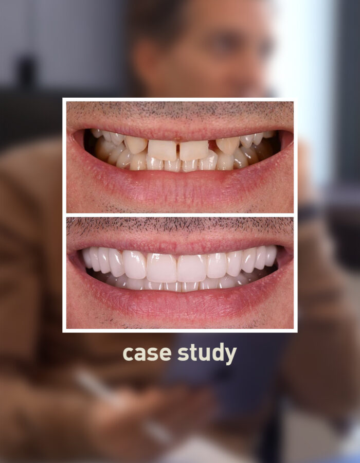 Split image showing a before and after of a dental case study. Top shows discolored, misaligned teeth; bottom shows straight, white teeth. A blurred person is in the background, focusing on the dental transformation.