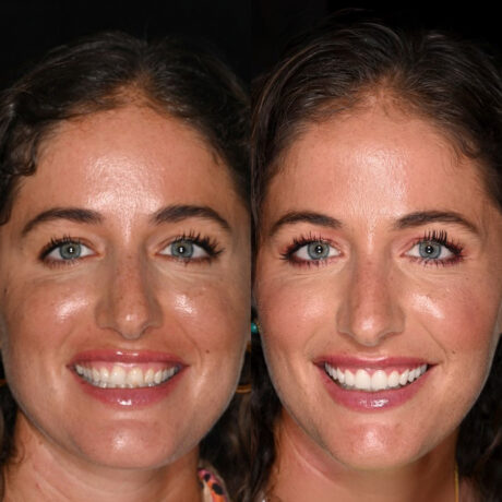 Side-by-side comparison of the same woman before and after a beauty treatment. The left image shows her with visible freckles and less makeup, while the right image shows her with a smoother complexion and enhanced makeup.