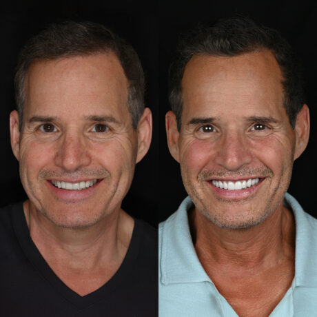 Two side-by-side images of a smiling man with short, dark hair. On the left, he wears a black shirt, and on the right, a light blue shirt. The background is black, highlighting changes in lighting and skin tone between the two photos.