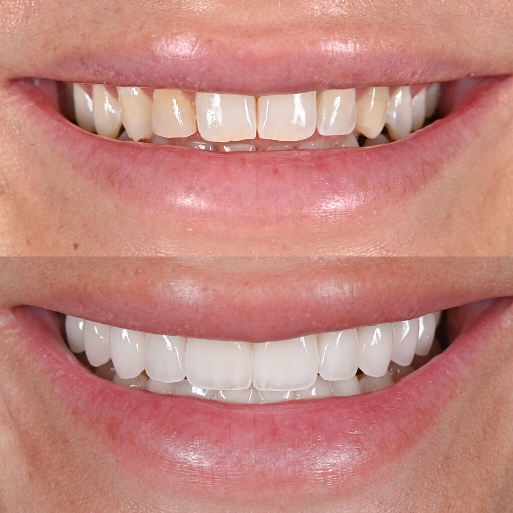 Smile transformation