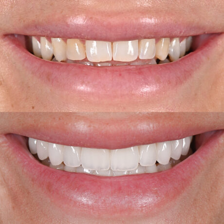 Close-up of two images of a persons smile. The top shows teeth with stains and slight gaps, while the bottom shows the same teeth after whitening and alignment, with a more polished appearance.