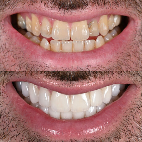 Side-by-side comparison showing two smiles: the top image features discolored, misaligned teeth, and the bottom image displays a bright, straight, and well-aligned set of teeth, highlighting a dental transformation.