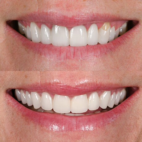 Close-up of a persons smile showing their teeth. The top image displays a chipped front tooth, while the bottom image shows the same teeth after repair, appearing smooth and uniform.