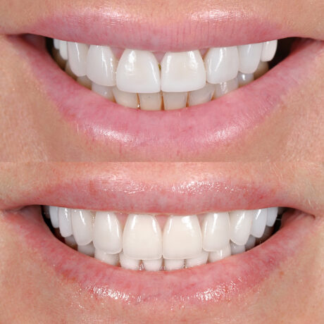 A close-up image showing a comparison of two sets of smiling teeth. The top set has uneven, slightly discolored teeth, while the bottom set displays white, even teeth, suggesting a dental treatment such as teeth whitening or veneers.