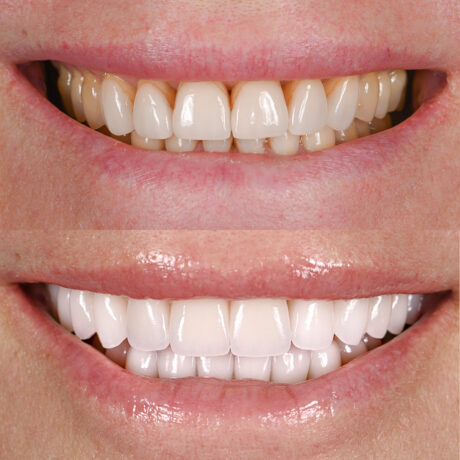 Close-up of two sets of teeth in a before-and-after comparison. The top image shows teeth that are slightly yellowed and uneven, while the bottom image depicts teeth that are whiter, straighter, and more uniform.