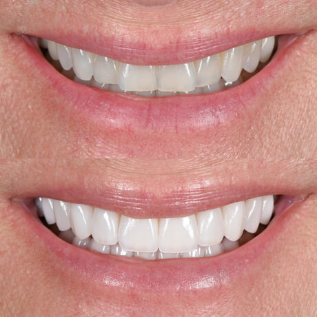 Close-up photo comparing two smiles. The top smile has slightly stained teeth, while the bottom smile shows bright, white teeth. Both images focus on the mouth and teeth only.