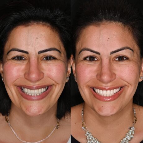 A side-by-side comparison shows a woman smiling, highlighting her teeth. The left image shows a less polished smile, while the right image shows whiter, more even teeth. She wears a necklace and earrings in both images.