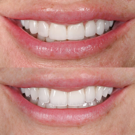 Close-up of two images showing a persons smile. The top image displays a before view of white teeth with slight gaps, while the bottom image shows an after view with perfectly aligned and improved teeth, suggesting dental work or enhancement.