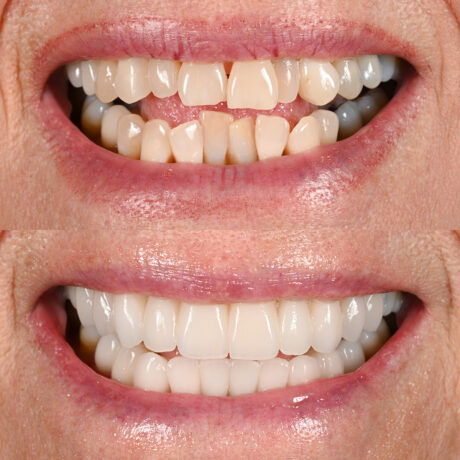 Before and after photo showing a persons teeth. The top image displays the teeth before, with some gaps and unevenness. The bottom image shows the teeth after a cosmetic dental procedure, appearing aligned, even, and white.