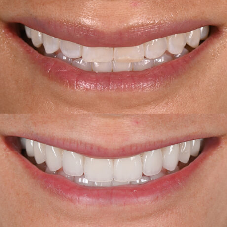 Close-up comparison of two smiles. The upper image shows natural teeth with slight discoloration, while the lower image displays whiter, more uniform teeth. Both images focus on the mouth area, highlighting the difference in tooth appearance.