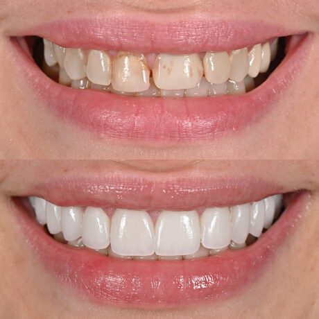 A side-by-side comparison of teeth before and after dental treatment. The top image shows discolored and uneven teeth, while the bottom image displays straight, white, and even teeth.