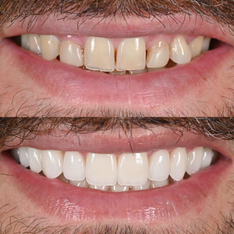 Close-up of two side-by-side images showing a dental transformation. The top image displays uneven, stained teeth with visible gaps. The bottom image shows straight, uniformly aligned teeth with a whitened appearance.