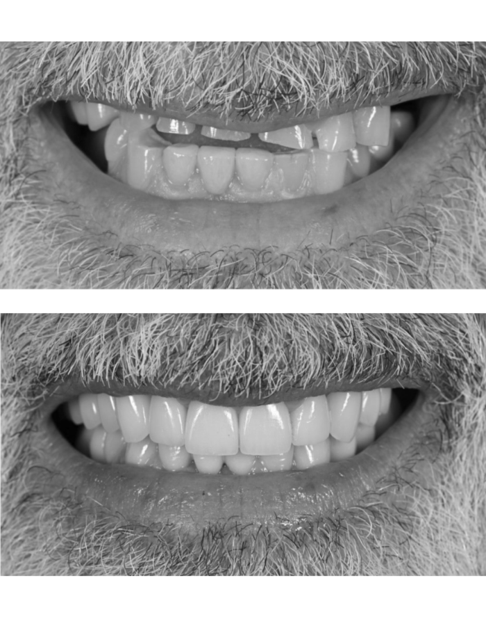 Two close-up black and white photos of a mans smile, showing a before and after. The top image shows uneven, worn teeth, while the bottom image shows straight, even, and restored teeth.